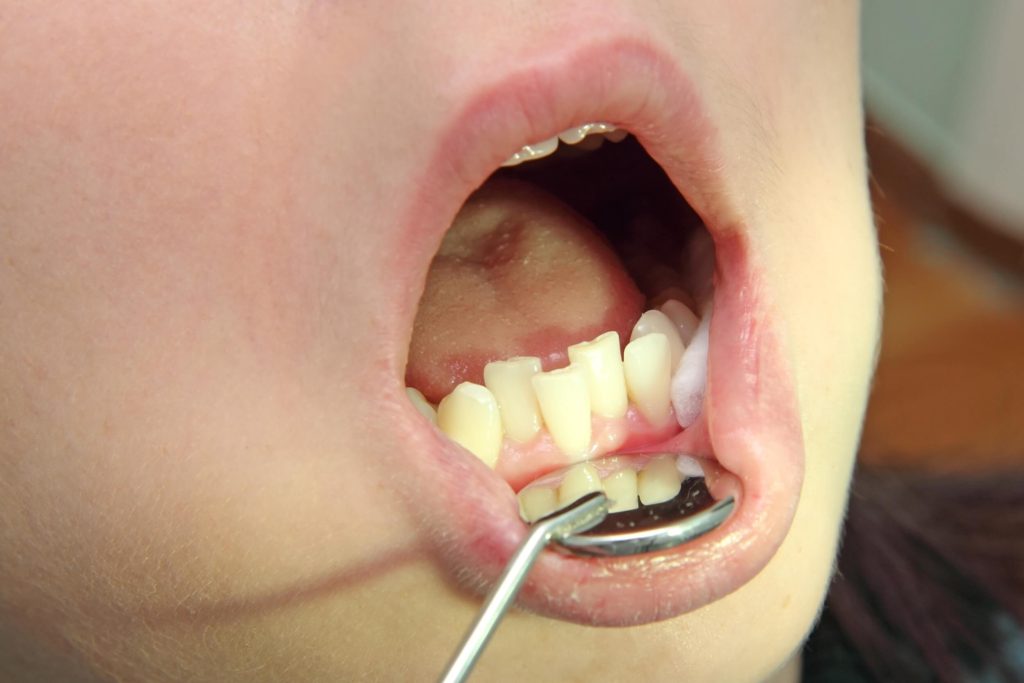 what to do about crooked teeth in children