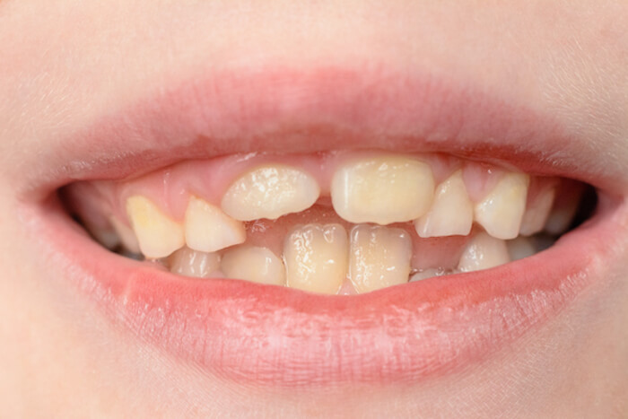 crooked teeth in children